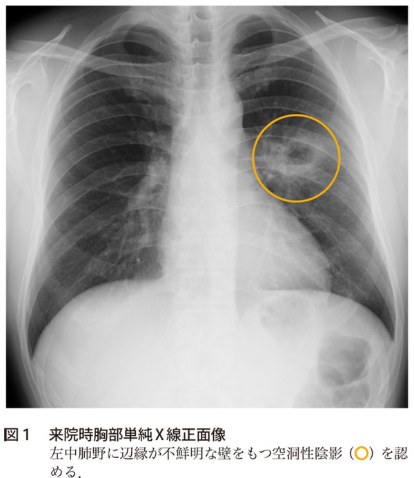 解答 解説 発熱 咳 空洞性陰影を認めた30歳代男性 実践 画像診断q A 羊土社 レジデントノート 実践 画像診断q A 羊土社 レジデントノート 羊土社