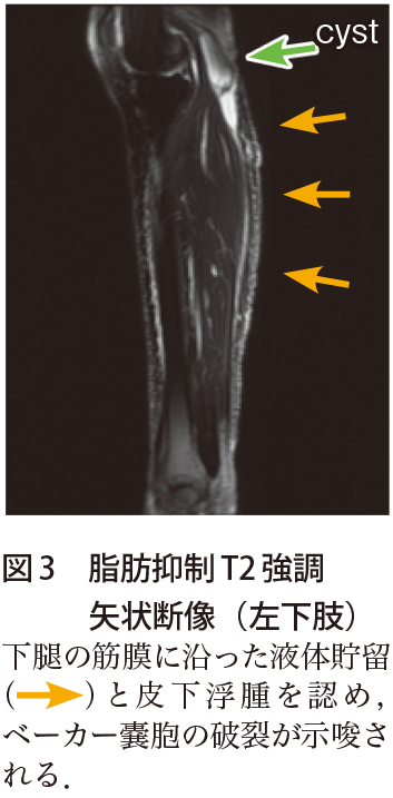 解答 解説 片側性下肢腫脹の原因は 実践 画像診断q A 羊土社 レジデントノート 羊土社