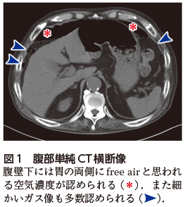 解答・解説】咳嗽悪化精査のX線で腹部の異常を指摘された80歳代男性 