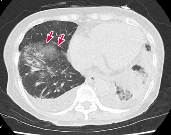 図8　追加で施行した症例の胸部CT