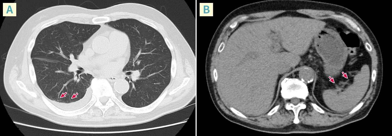図2　症例の胸部CT画像（A）と腹部CT画像（B）