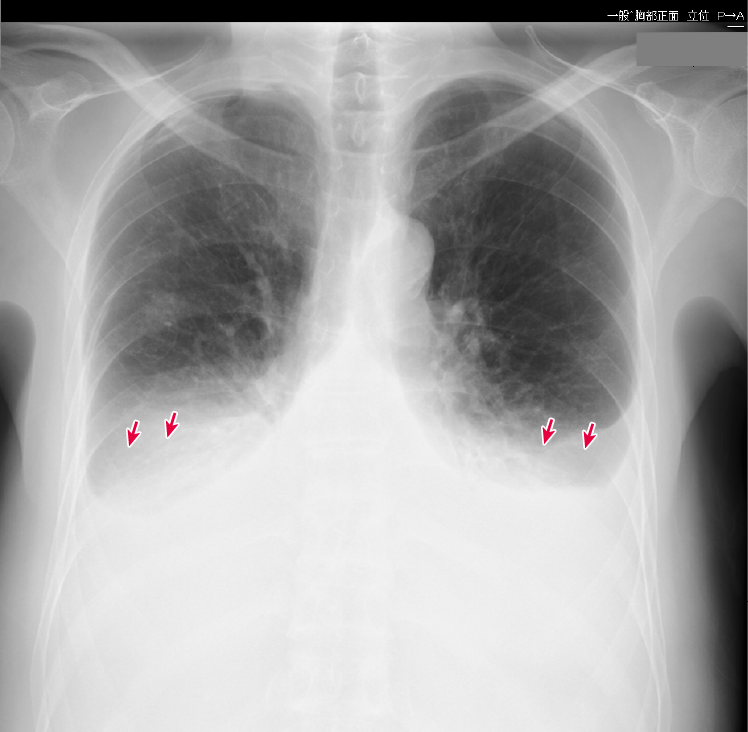 図4　症例の胸部X線画像