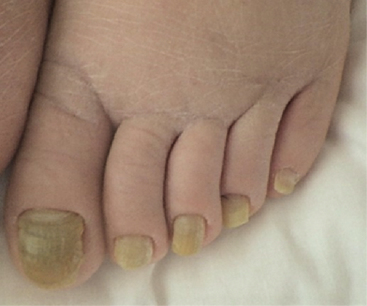 図5　症例の足の爪の所見