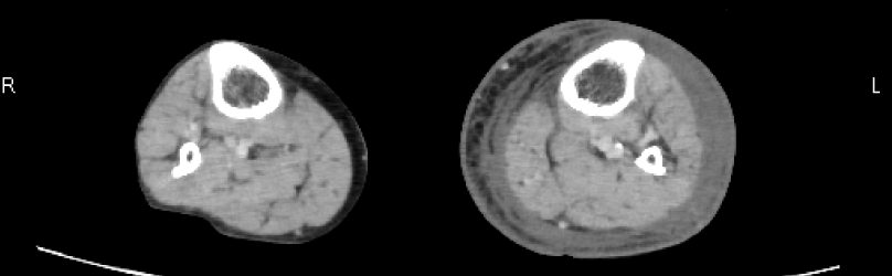 図3　下肢の造影CT