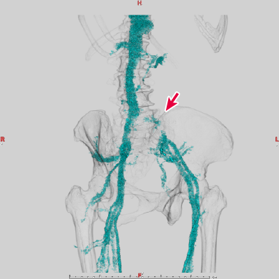 図5　3DCTで静脈を再構成した画像