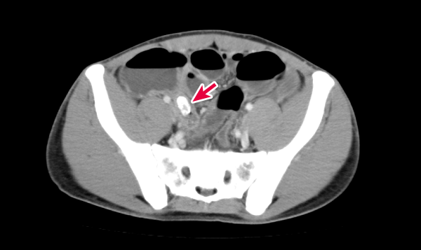 図4　症例1（Aさん）の腹部造影CT