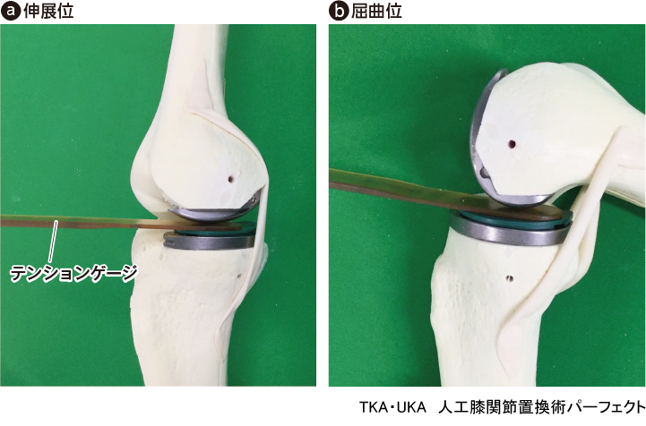 TKA・UKA 人工膝関節置換術パーフェクト〜人工膝関節全置換術・人工膝 